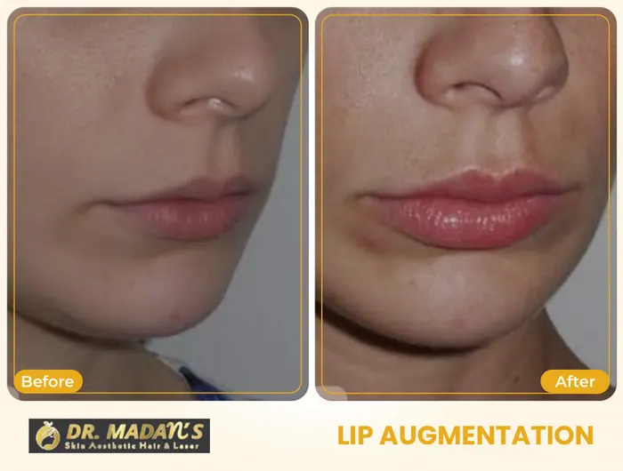 Lip augmentation before and after result 2 at Dr Madan Aesthetics